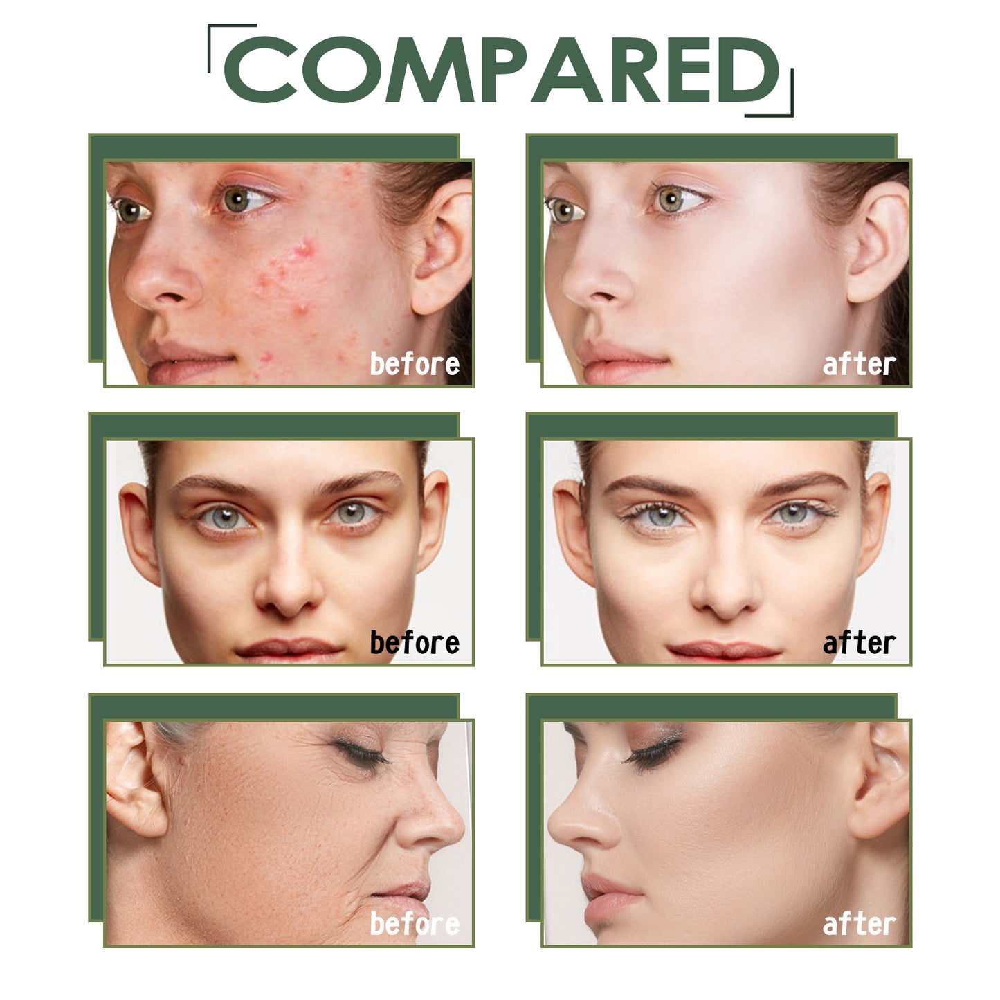 Acne Marks Blackhead Brightening Skin